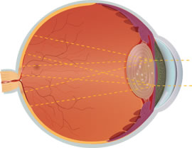 Cataracts eye cross section diagram